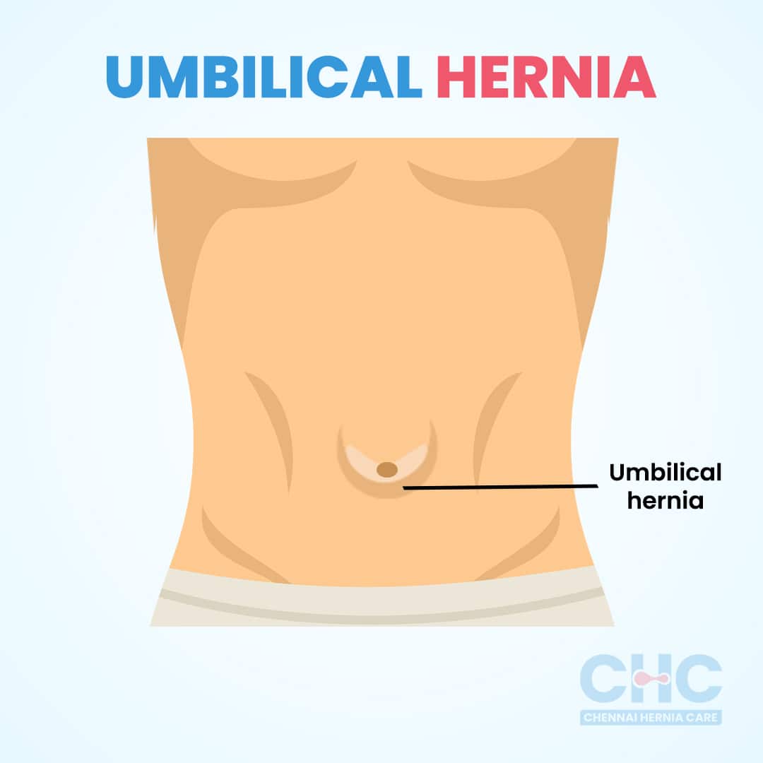 Umbilical Hernia Chennai Hernia Care Hernia Specialists in Chennai