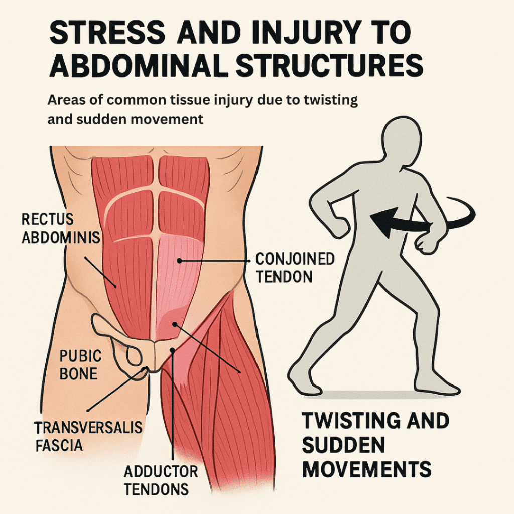 Sports Hernia - How Twisting Movements Stress the Pubic Region
