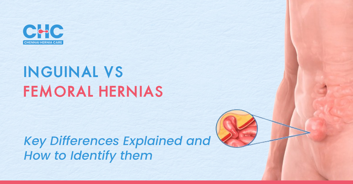 Inguinal vs femoral hernia