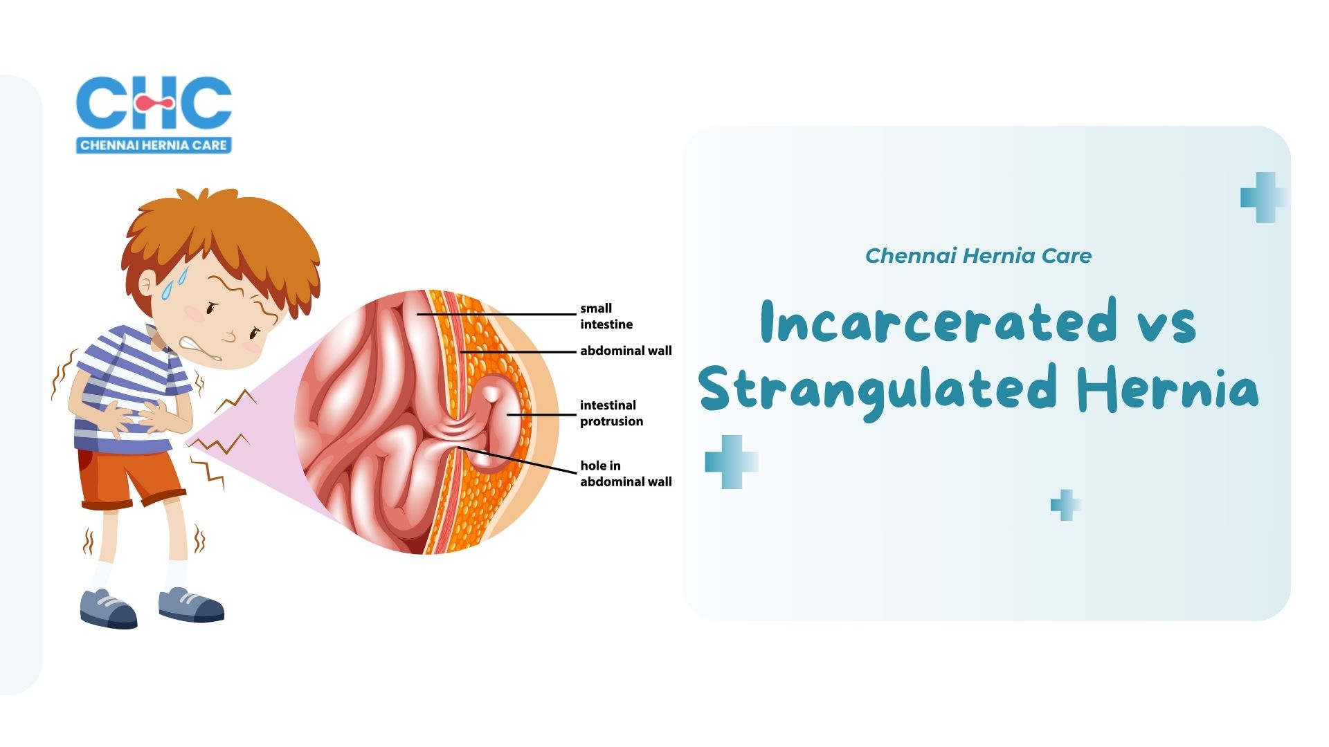 Incarcerated Vs Strangulated Hernia