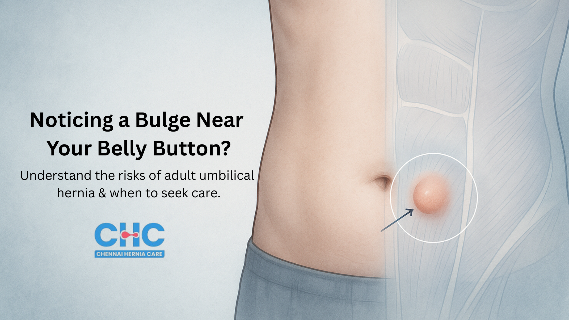 Medical illustration showing abdomen with umbilical hernia bulge near navel, marked with soft clinical overlays.