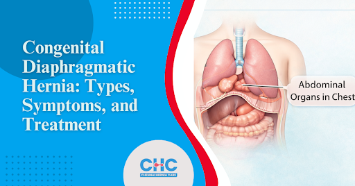 Congenital diaphragmatic hernia with abdominal organs displaced into the chest cavity.